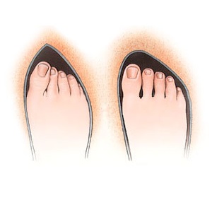 الأحذية الضيقة ورفيعة المقدمة من الأسباب الرئيسية لظهور بروز العظام في القدم الأحذية الضيقة ورفيعة المقدمة من الأسباب الرئيسية لظهور بروز العظام في القدم