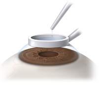 العناية بالعين بعد عملية الليزك