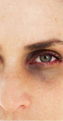 حقيقة الهالات السوداء: الأسباب والعلاقة مع الأمراض