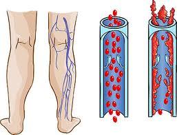 سلسلة رمضان: جلطات الأوردة وشهر رمضان ج2