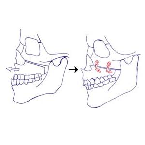 بروز الفكين عند الأطفال
