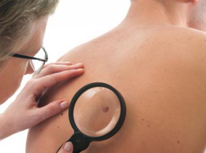 أورام الجلد