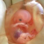 الإجهاض قد يكون نعمة