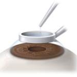 العناية بالعين بعد عملية الليزك