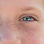 التصبغات الجلدية... أسبابها وطرق علاجها