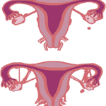 إلتصاقات ما بعد الولادة: أسباب ونتائج وعلاج