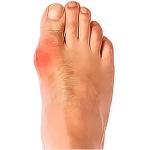 بروز عظام القدم