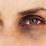 حقيقة الهالات السوداء: الأسباب والعلاقة مع الأمراض