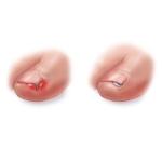 إنغماس الأظافر