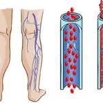 سلسلة رمضان: جلطات الأوردة وشهر رمضان ج2