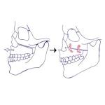 بروز الفكين عند الأطفال