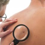 أورام الجلد